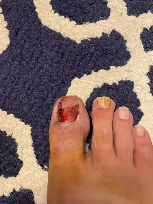 Ingrown on both sides. Whole nail had to come out