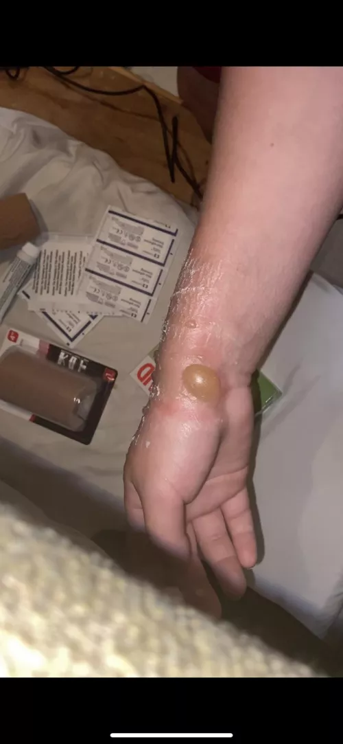 2nd degree temptation to pop