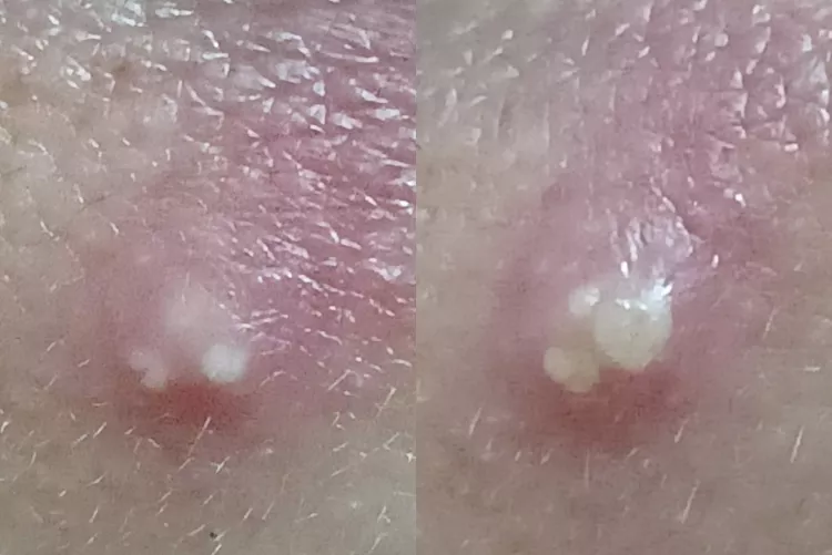 my my, look how she grows [pic] [pimple on lower lip]