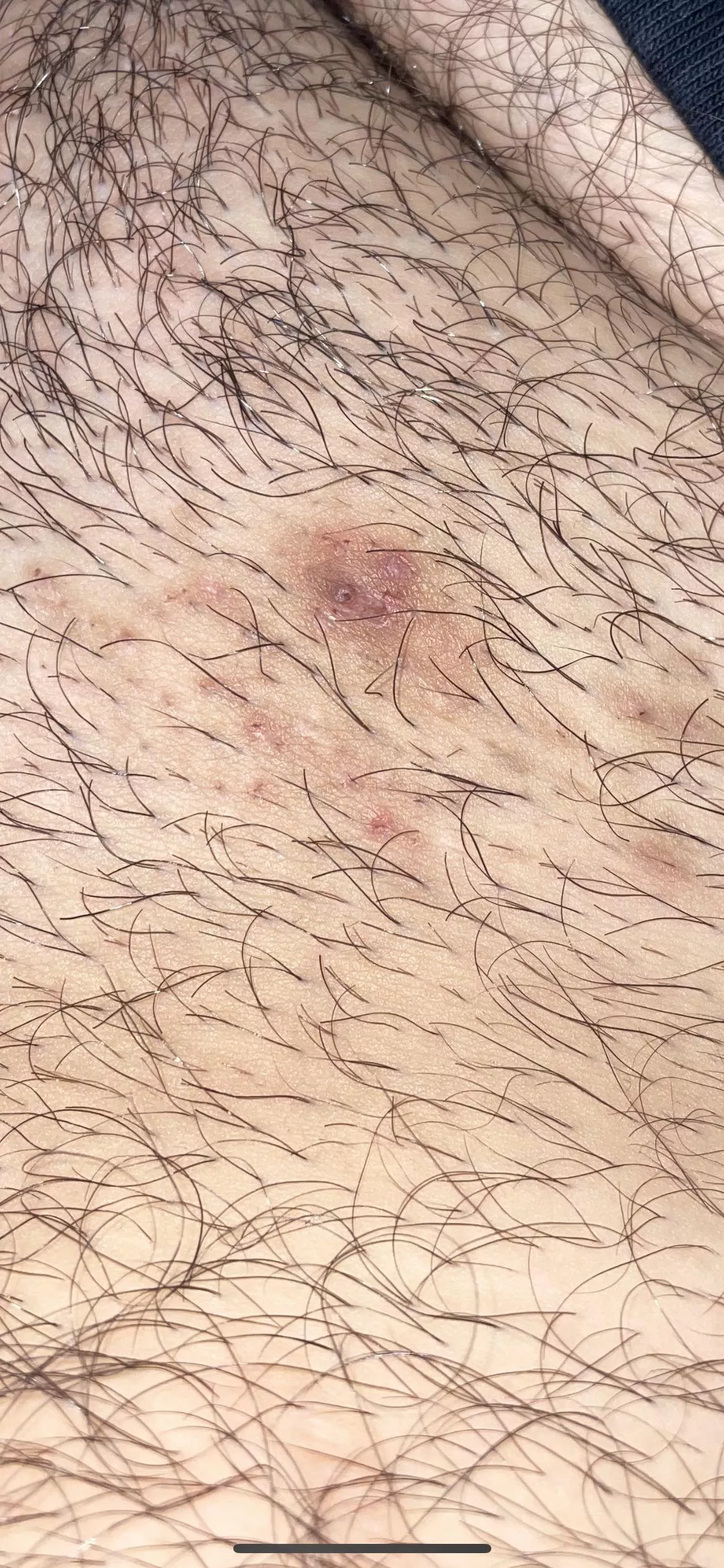 Ingrown hair in the pubic area that’s been there for a year now. Popped it before, tried picking at it multiple times. When I try to squeeze it now, nothing happens. Any ideas or recommendations? Ingrown hair in the pubic area that’s been there for a year now. Popped it before, tried picking at it multiple times. When I try to squeeze it now, nothing happens. Any ideas or recommendations?