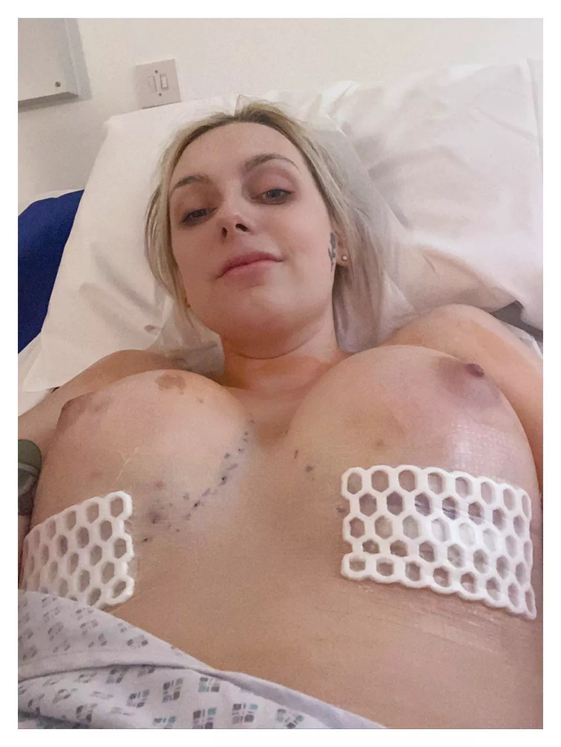 Just otu of surgrey! Still super sore and achey, but everything went well and m happy/healthy. Went from 34B to a 34E Just otu of surgrey! Still super sore and achey, but everything went well and m happy/healthy. Went from 34B to a 34E