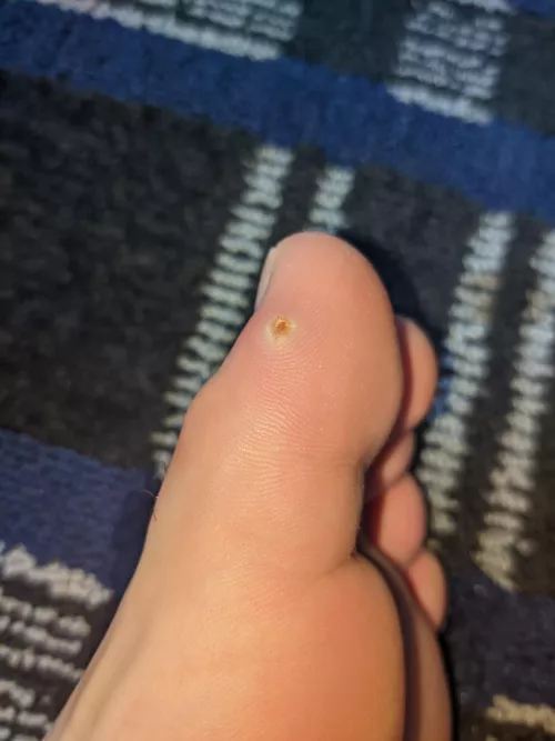 Cut my foot on a coral while surfing in Hawaii, now it turned into this 3 weeks later. Is it infected?