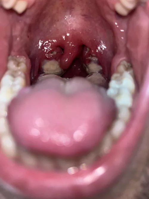 Infected with Mono and tonsillitis 😍 worst pain