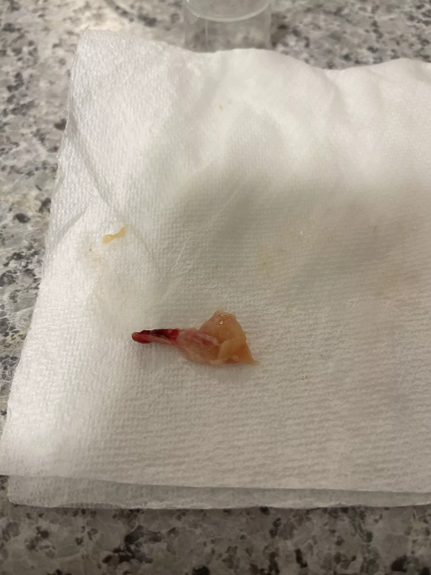 Fighting off a flu / cold, blew this nasal polyp out. I suspected I have had this for awhile but this surprised me. Will be seeing an ENT as soon as possible. Fighting off a flu / cold, blew this nasal polyp out. I suspected I have had this for awhile but this surprised me. Will be seeing an ENT as soon as possible.
