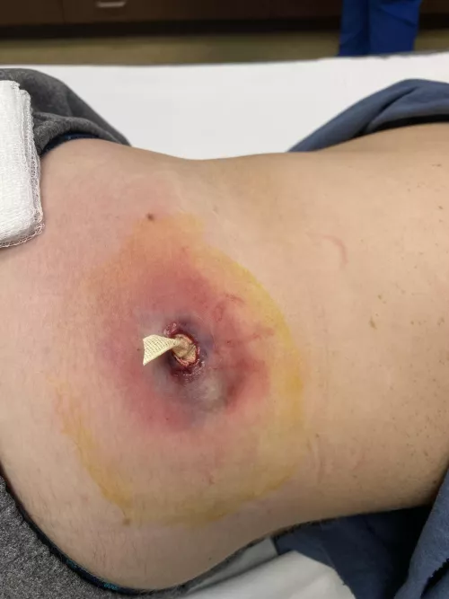 Sebaceous Cyst drained and packed. Ask away with questions!