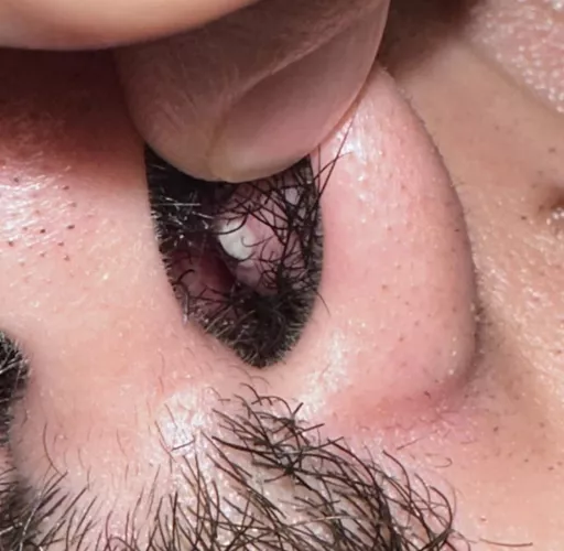 To pop or not to pop? Got a zit inside my nose. It hurt a lot during the night but it’s getting a little better and is improving. I am Mexico and went to the doctor and she gave by oral antibiotics and told me not to mess with it and go to a ENT if it 