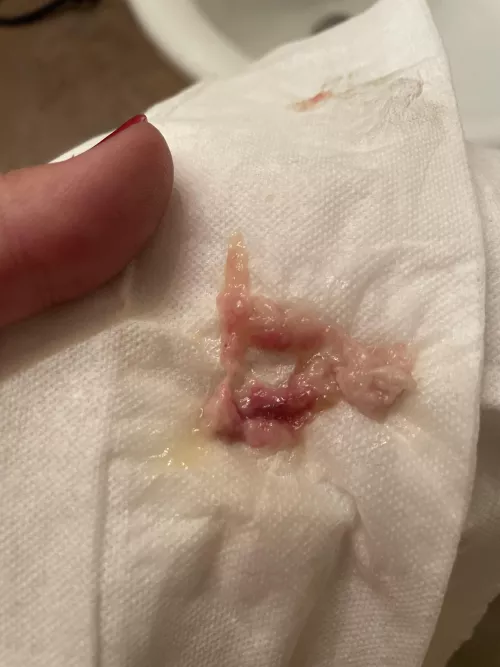 Nose polyp I didn’t know I had. My ears started ringing and I felt congested, blew it right out. Sent a pic to ENT because I didn’t know what it was!