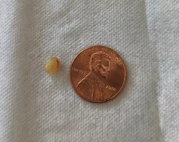 This little guy came out of my head this morning. Keratin cyst.