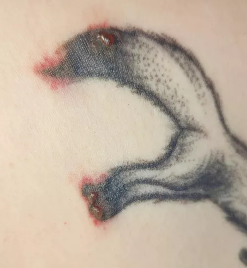 Forbidden pops...laser tattoo removal patch test today. Must resist...