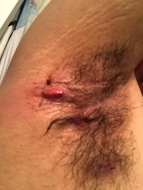 Painful armpit boil begging to be popped