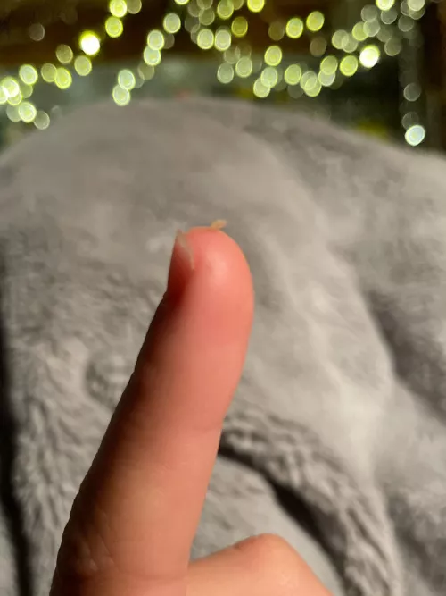 Been trying to get this out of my back for ages- finally managed to squeeze it out! Was starting to think i was messing with a mole or scar or something 😅