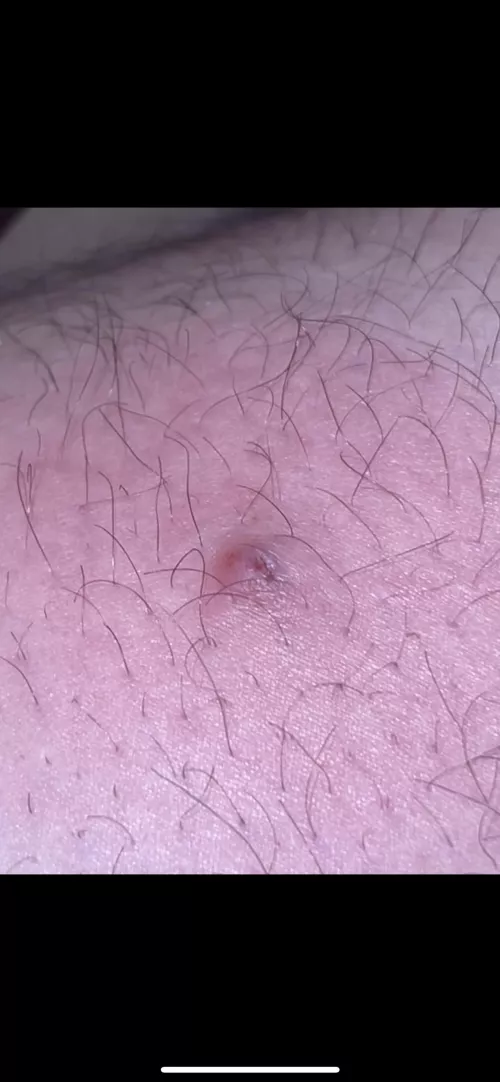 Before I rush to ER is this a spider bite or an ingrown hair? Hurts pretty darn bad.