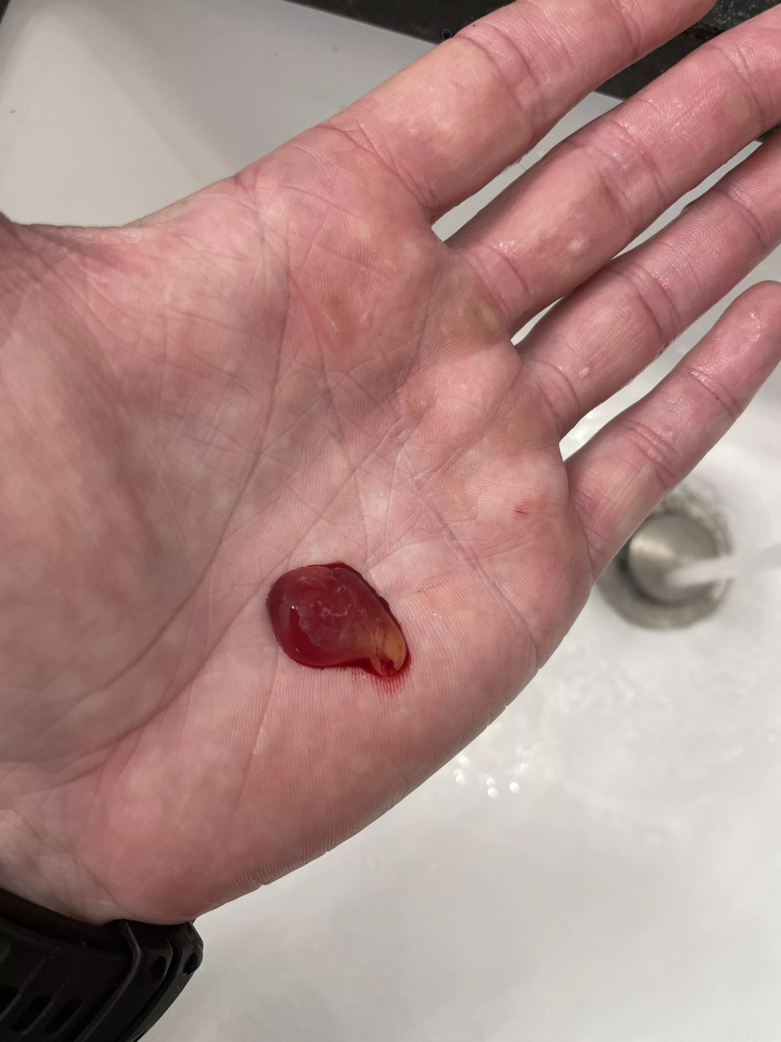 Blew this out of my nose this morning. Then epistaxis followed. Consistency of a fruit chew, but I could breathe so well! Blew this out of my nose this morning. Then epistaxis followed. Consistency of a fruit chew, but I could breathe so well!