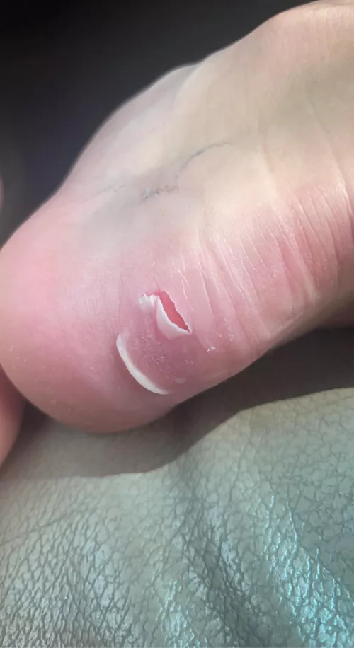 Blister I formed on my heel from steel toe boots. Felt it pop this morning.