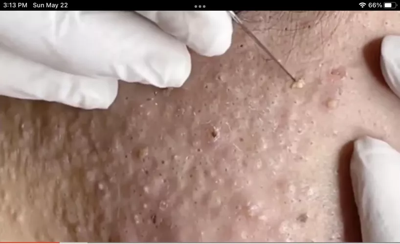 Can anyone source this video? The content is epic, but the link I have is totally stolen! I am afraid to post it here and break any rules… No glove markings, uses a scalpel. I have seen other similar content and would love to find the originals!
