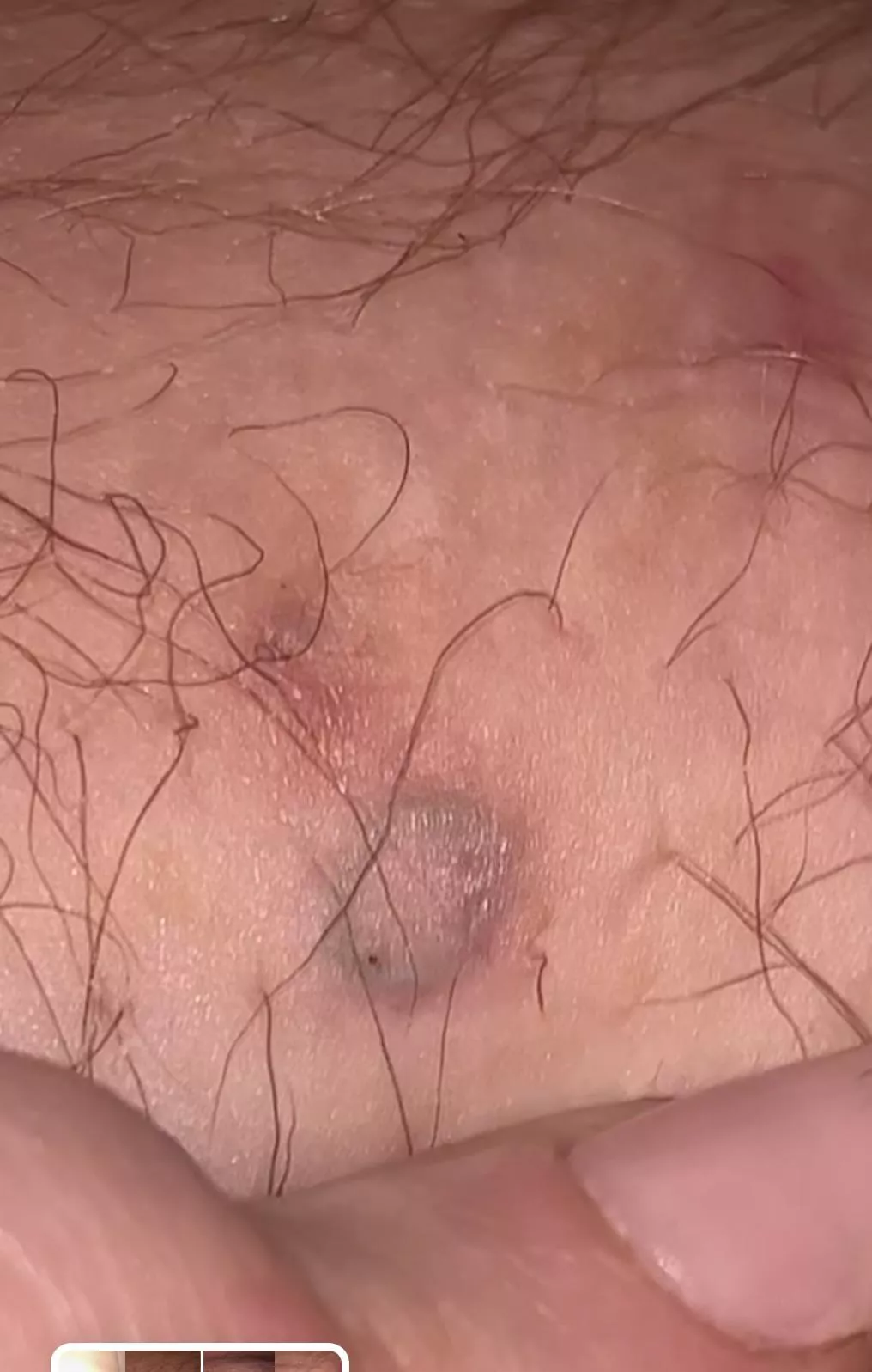 Can anyone tell what this is? I think it’s just a REALLY old ingrown but it feels like a rubber band underneath my skin. Can anyone tell what this is? I think it’s just a REALLY old ingrown but it feels like a rubber band underneath my skin.