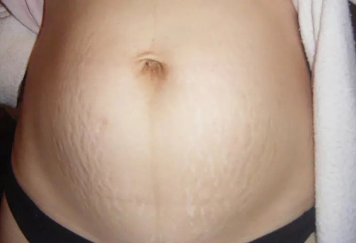 Can share code any idol that she ever gave birth and her body has belly strech please ??