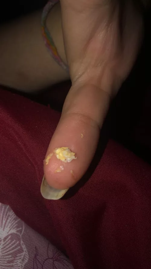 Cyst? gunk. had a small bump on the hood of my clitoris. didn’t know it was a cyst until it was hurting this morning. sadly no video, but some gunk!