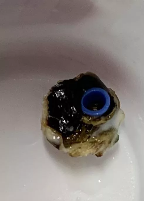Ear tube fell out after 6 months. I can hear again.