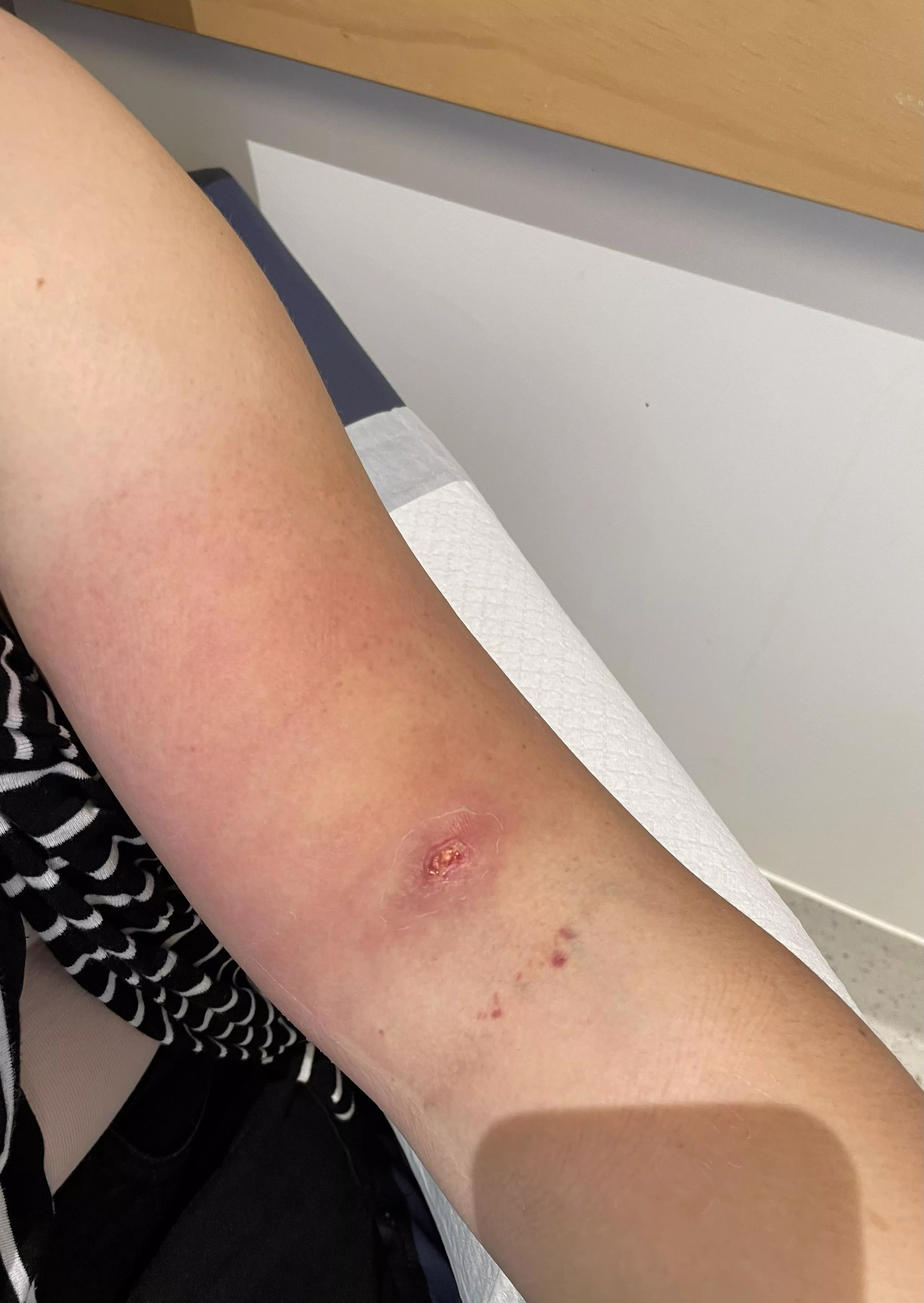Final update: Arm infection has drastically improved! Thanks for following along (bonus video in comments) Final update: Arm infection has drastically improved! Thanks for following along (bonus video in comments)