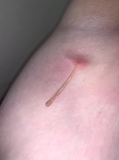 Finally some relief after four days of antibiotics