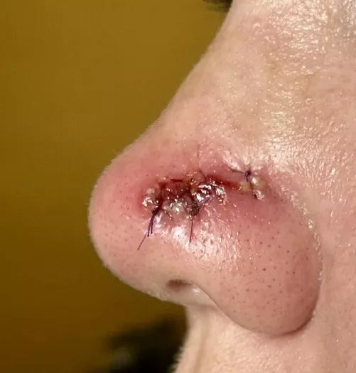 Forbidden pops. Had a reaction to the sutures!