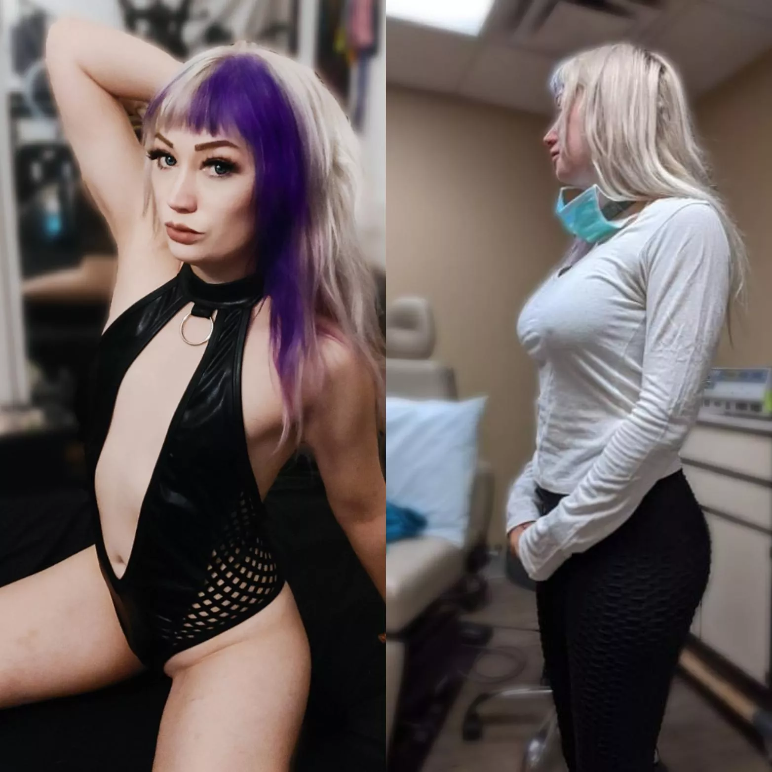 Getting my first suregry tomorrow! Left is before and right is the try on.