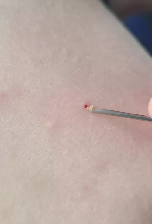 Giant hole left in my bfs shoulder from this blackhead