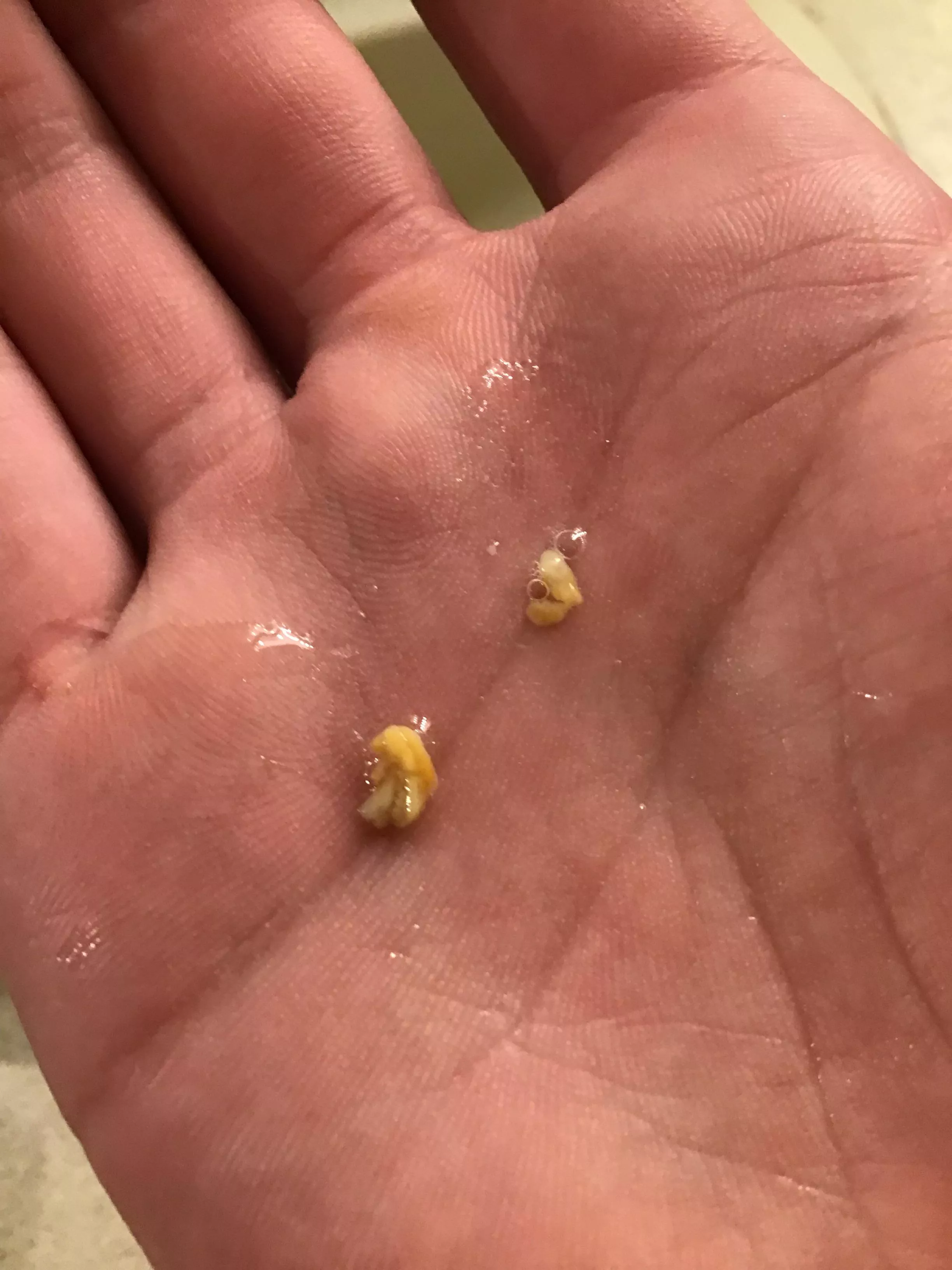 Had some of what I presume to be tonsil stones that came out of my throat. I could feel them for a few days like something stuck there Had some of what I presume to be tonsil stones that came out of my throat. I could feel them for a few days like something stuck there