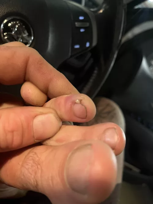 Had to deal with my home toenail surgery infection all day. Couldn’t wait to get my boot off. Yes it was wrapped and had antiseptic cream on it. Felt so good to squeeze.