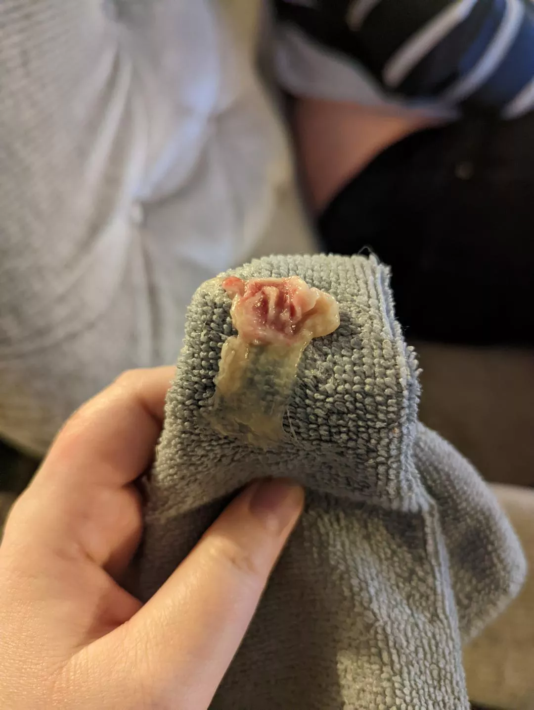 Had tonsilitis. This came out of my mouth. Dr checked and says half of my tonsil is missing and there's a massive hole where flesh should be. Anyone had this happen before? Dr thinks the tissue got infected and died. Not technically anything popping! Had tonsilitis. This came out of my mouth. Dr checked and says half of my tonsil is missing and there's a massive hole where flesh should be. Anyone had this happen before? Dr thinks the tissue got infected and died. Not technically anything popping!