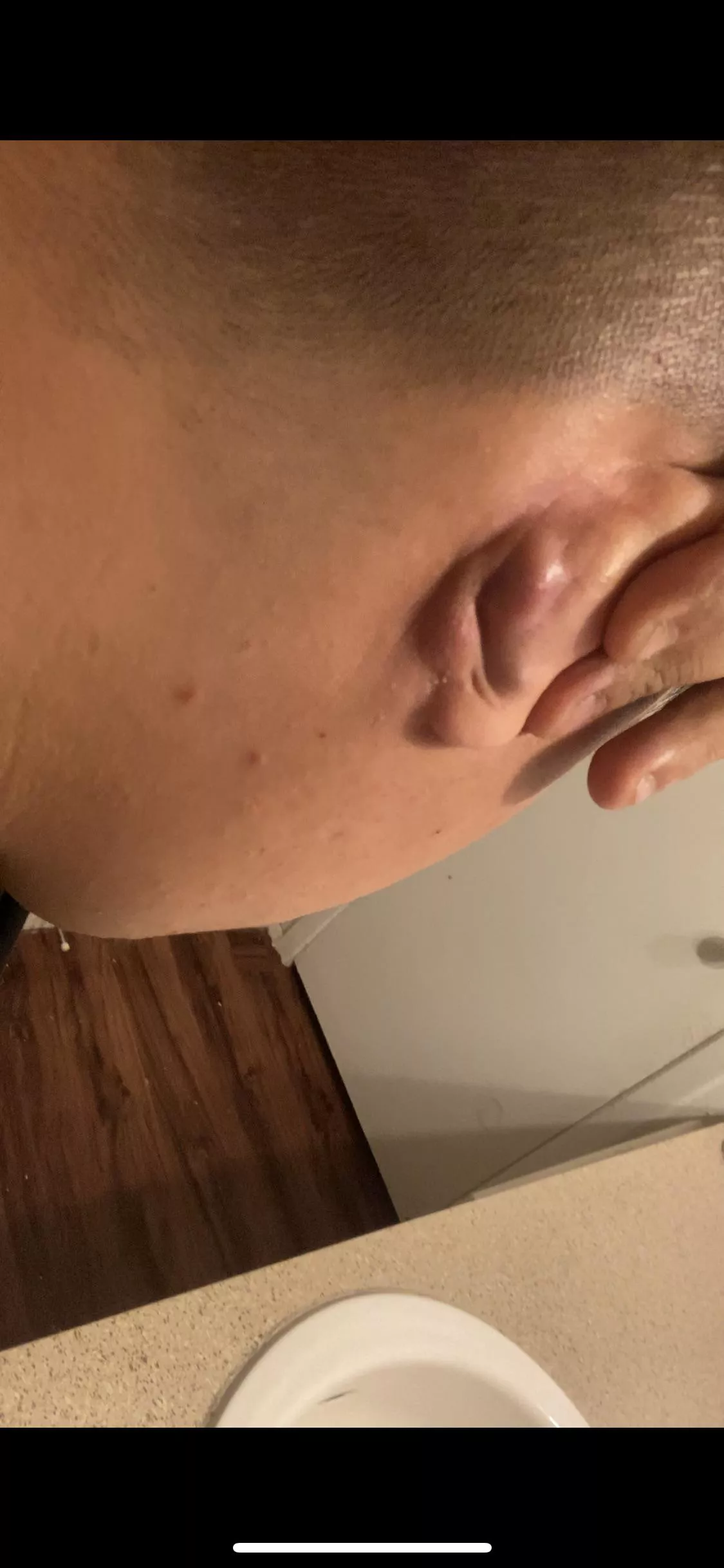Hello should I be worried about this behind my ear I originally had a big “ cyst “ behind my ear it drain by it self an now I have two “ cyst “ Hello should I be worried about this behind my ear I originally had a big “ cyst “ behind my ear it drain by it self an now I have two “ cyst “