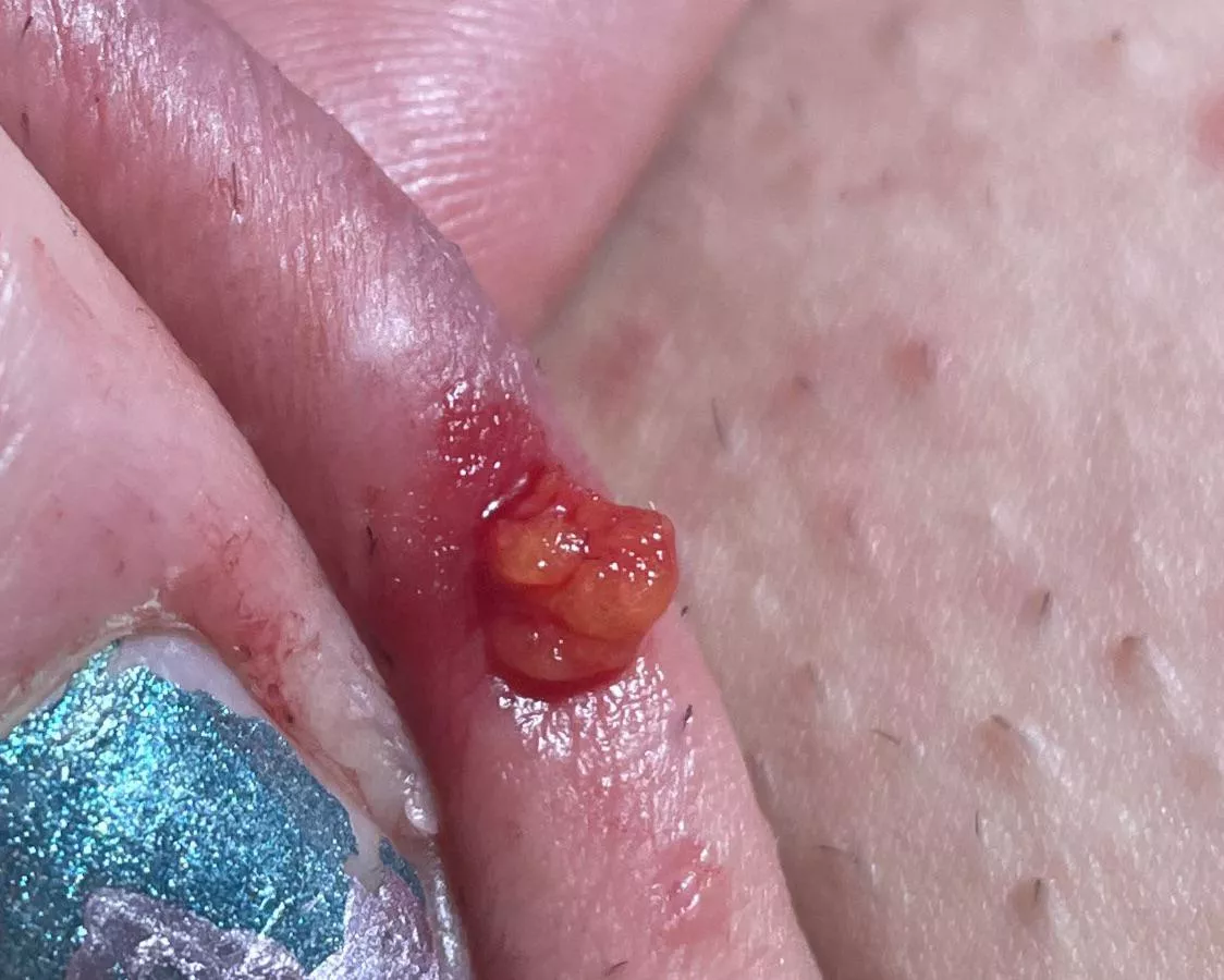 Help! What is this? After digging out an ingrown hair I started to pull this stuff out… is it a cyst?