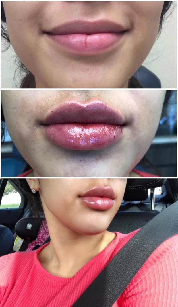 Hi I’m Amy Delavega and I’m addicted to lip fillers