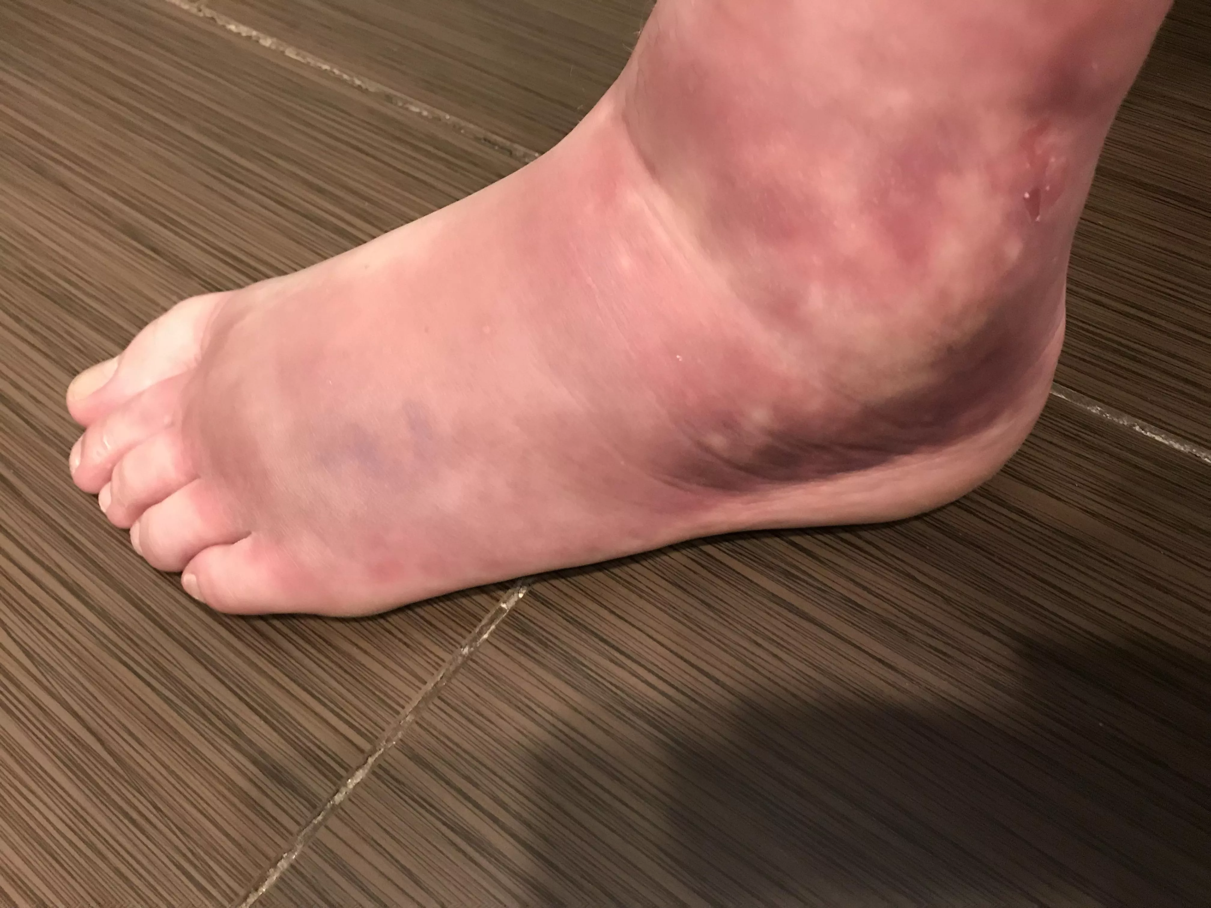 High heel injury - torn ankle ligaments that required surgery after a trip over a curb. Anyone else have a good story about a fall in heels? High heel injury - torn ankle ligaments that required surgery after a trip over a curb. Anyone else have a good story about a fall in heels?