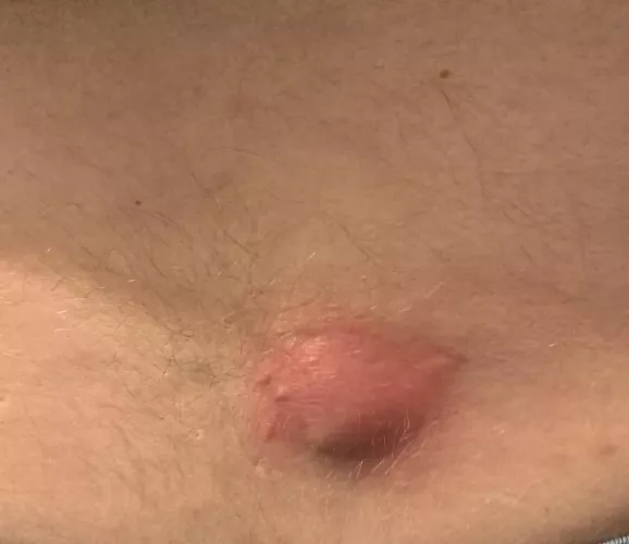 Husband’s back cyst (info in comments)