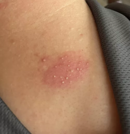 I don’t know what caused this. Bug bite? Want to pop.