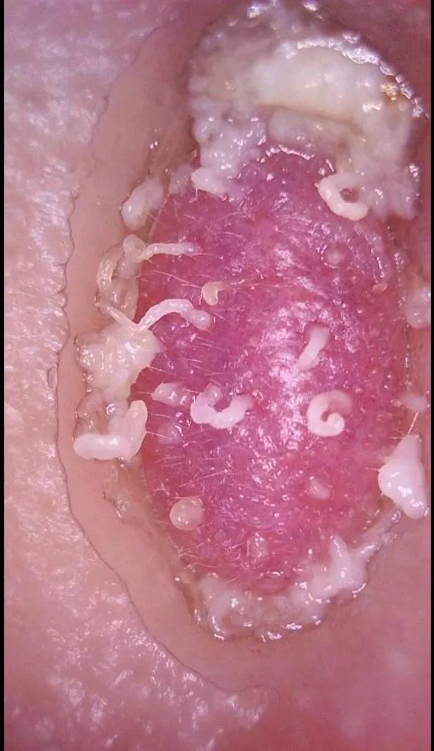 I got a new zit sucker and wanted to share my nose gunk. It wont let me upload the video so this was the next best thing. I got a new zit sucker and wanted to share my nose gunk. It wont let me upload the video so this was the next best thing.