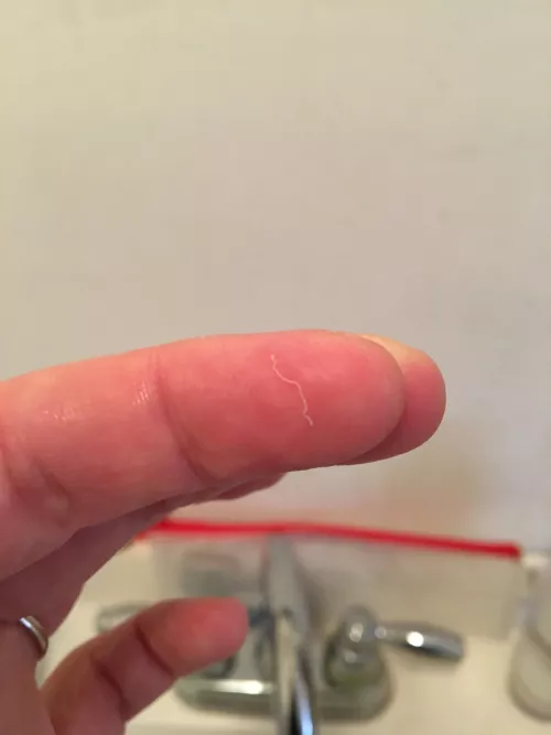 I had the tiniest cyst ever on my jawline and this is what it produced