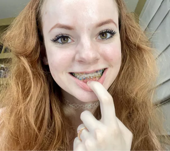 I love my braces ❤️ I never want them taken off