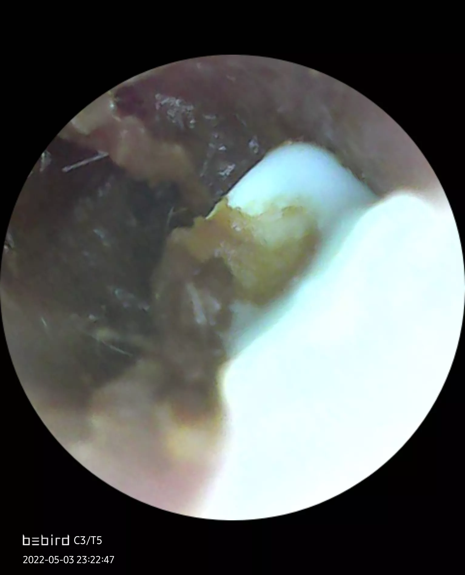 I present to you: A wax blockage from my very own ear