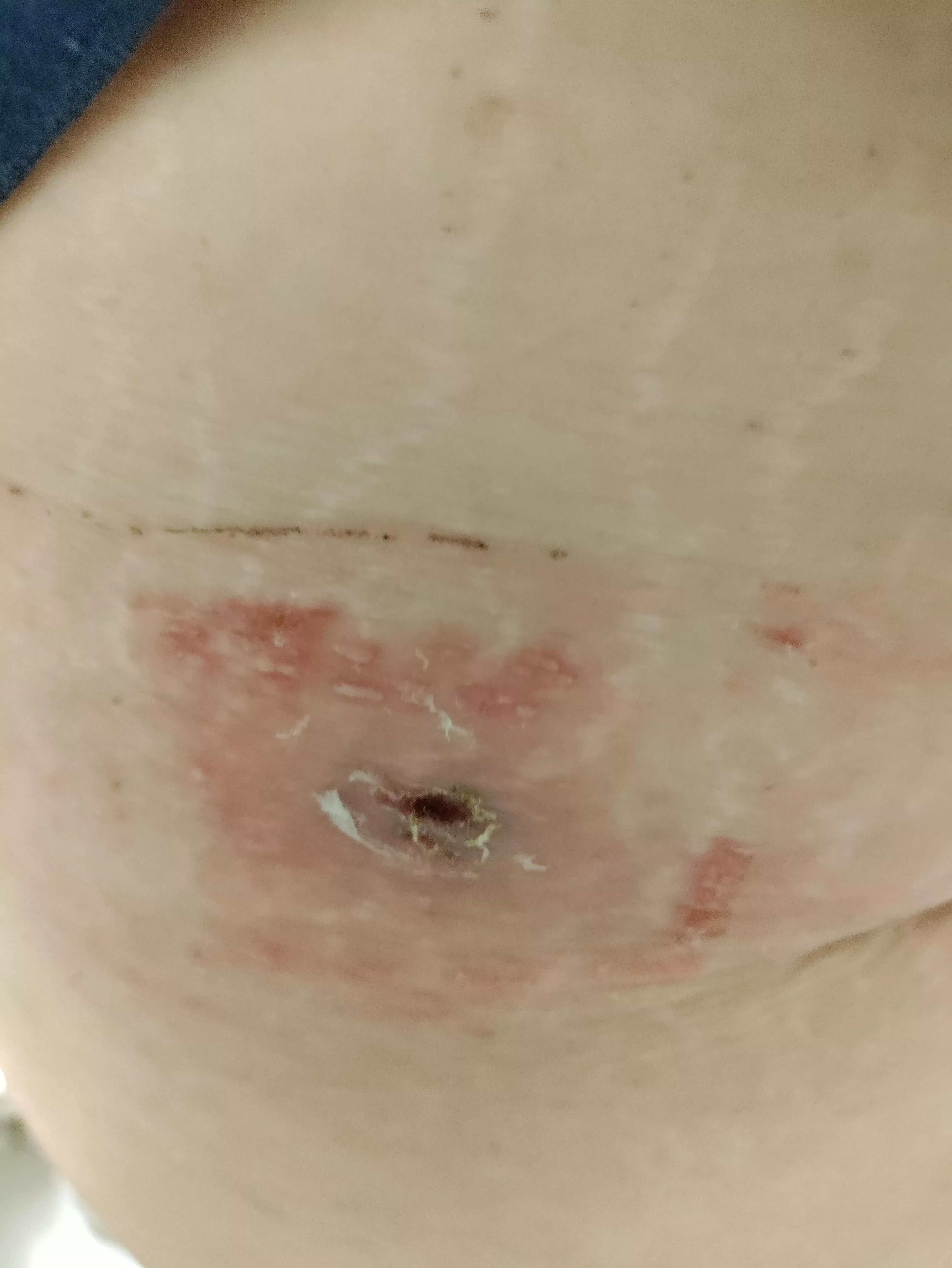 I put a bandaid with Boil-Ease over a boil on my side. I guess I'm allergic to the padding because these little bumps of fluid and irritation started popping up all around the boil. I've used Boil-Ease without any issue before but these bandaids are ne I put a bandaid with Boil-Ease over a boil on my side. I guess I'm allergic to the padding because these little bumps of fluid and irritation started popping up all around the boil. I've used Boil-Ease without any issue before but these bandaids are ne