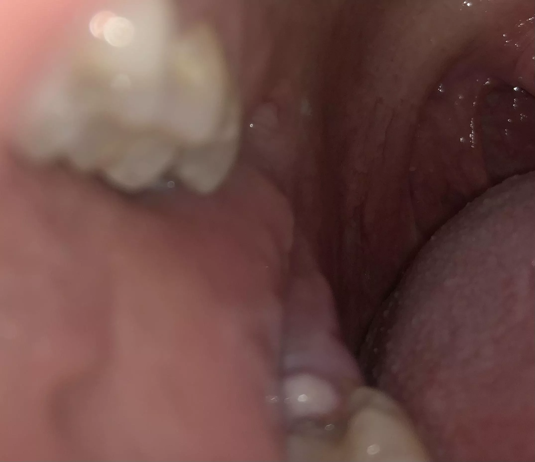 Infected operculum - pericoronitis. An infected flap of gums that falls across the molar. It hurts like hell. On antibiotics. I apologize for nothing. Infected operculum - pericoronitis. An infected flap of gums that falls across the molar. It hurts like hell. On antibiotics. I apologize for nothing.