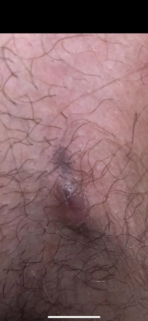 Is this ingrown hair or something else, its right next to ny balls. It like a dark underskin line that is soft to touch but it cant be popped. Its also like a little bump.