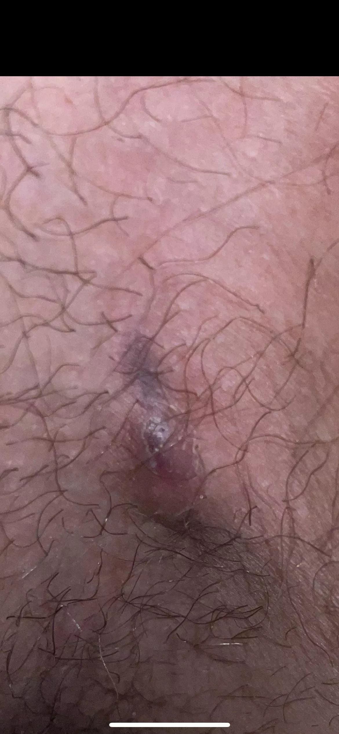 Is this ingrown hair or something else, its right next to ny balls. It like a dark underskin line that is soft to touch but it cant be popped. Its also like a little bump. Is this ingrown hair or something else, its right next to ny balls. It like a dark underskin line that is soft to touch but it cant be popped. Its also like a little bump.