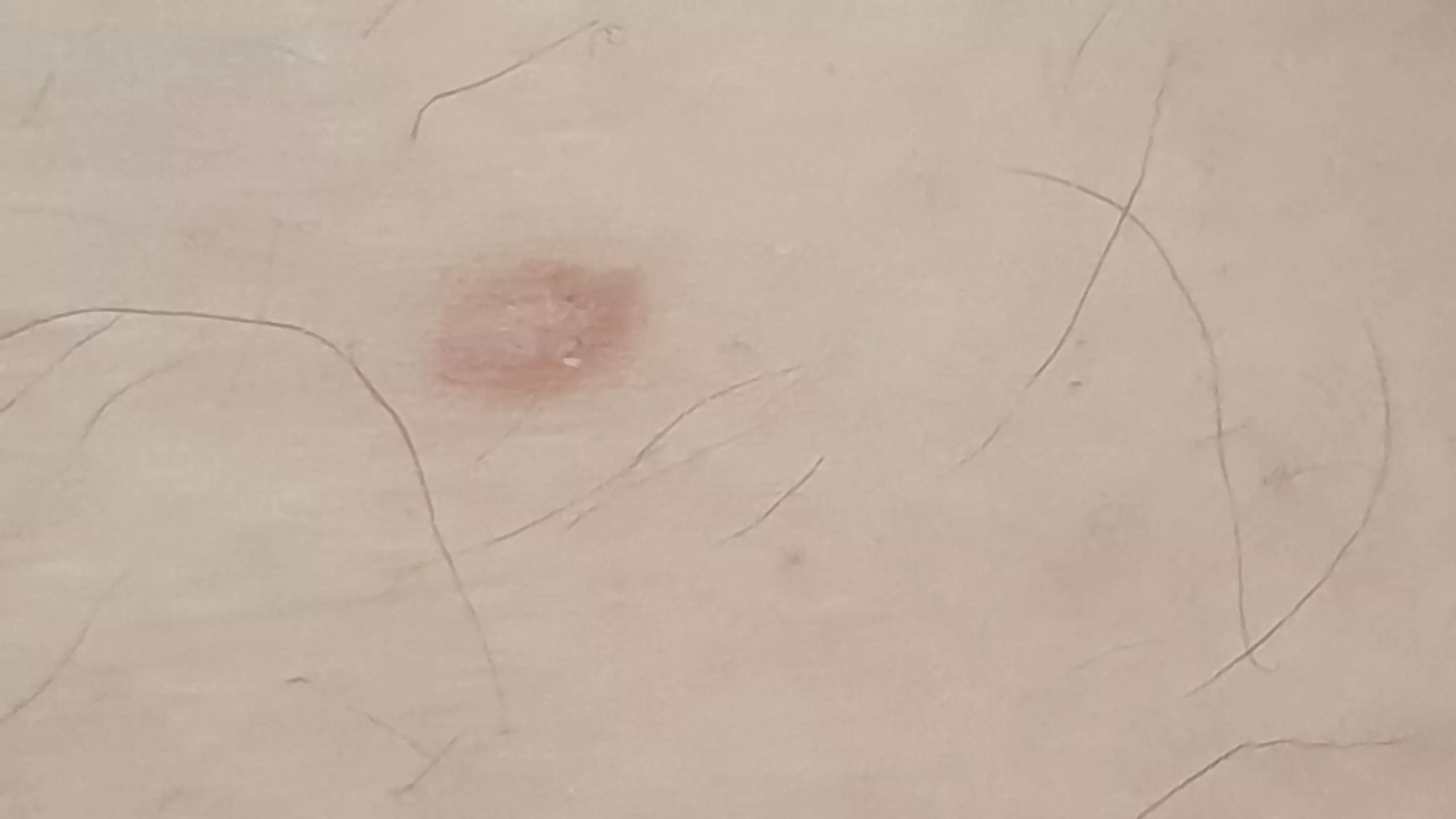I've had this on my inner thigh for years, its hard as a rock and looks I've had this on my inner thigh for years, its hard as a rock and looks