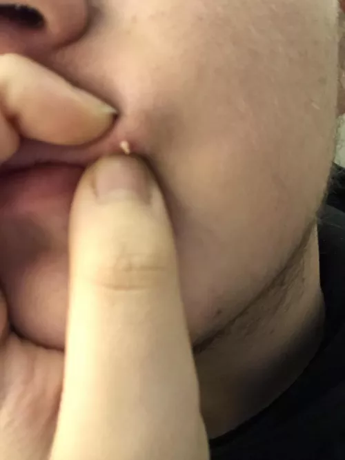 Just got this bastard out and it hurt like hell