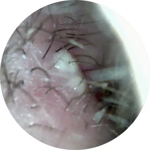 Long time lurker first time poster. Double nostril pops that I just can’t get. The frustration is unbearable!