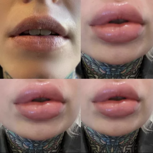 loving my lips this time around. Before and after 😘