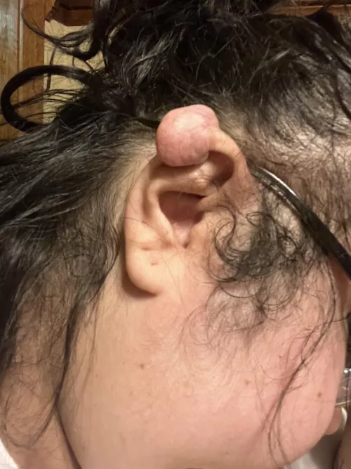 Meet the keloid that refuses to leave!! I’ve had my ear operated on 3 different times to get rid of it. The last time I got it removed the surgeon said this was the last time he’d do it because I obviously wasn’t taking care of my self.